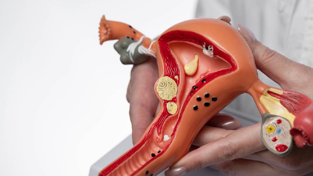 natural fibroid shrinkage