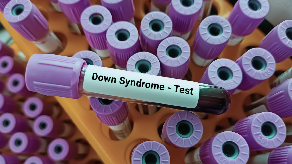 pregnancy scanning for Down syndrome done
